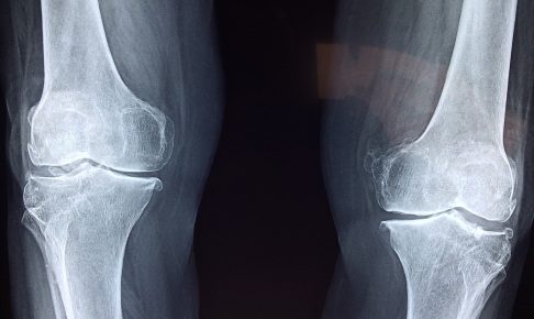 膝が痛い人のレントゲン
